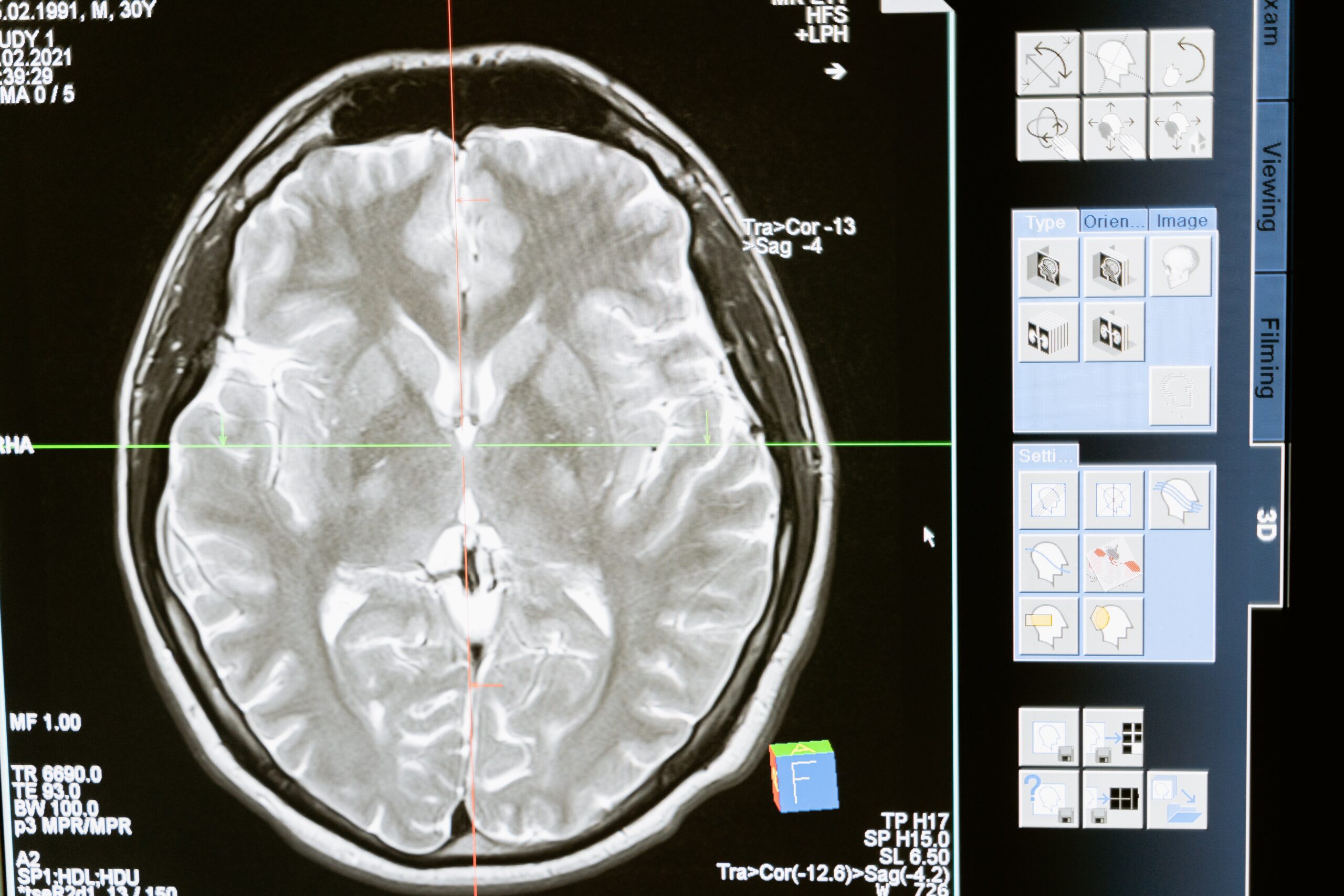 Guide to Parkinson’s Disease (Part 1 of 2: The basics)